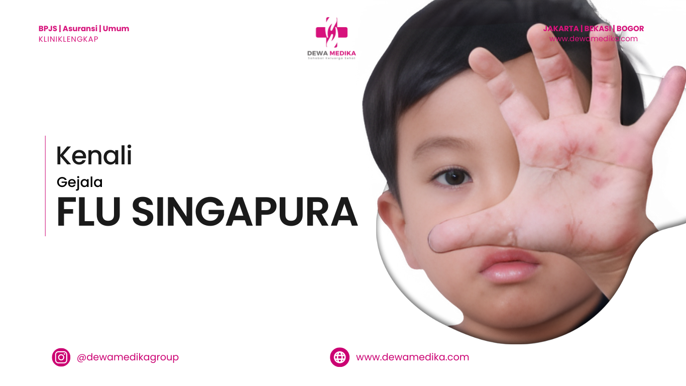 Apa itu Flu Singapura?